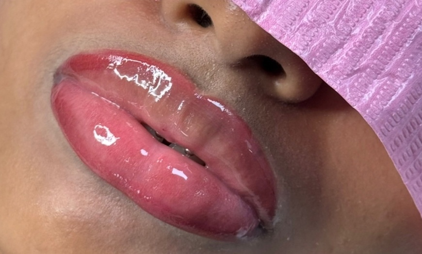 Image 4: Enhance w/ 0.5, 1, 2ml Lip Filler or  0.5ml Lip Filler + Smile Lines