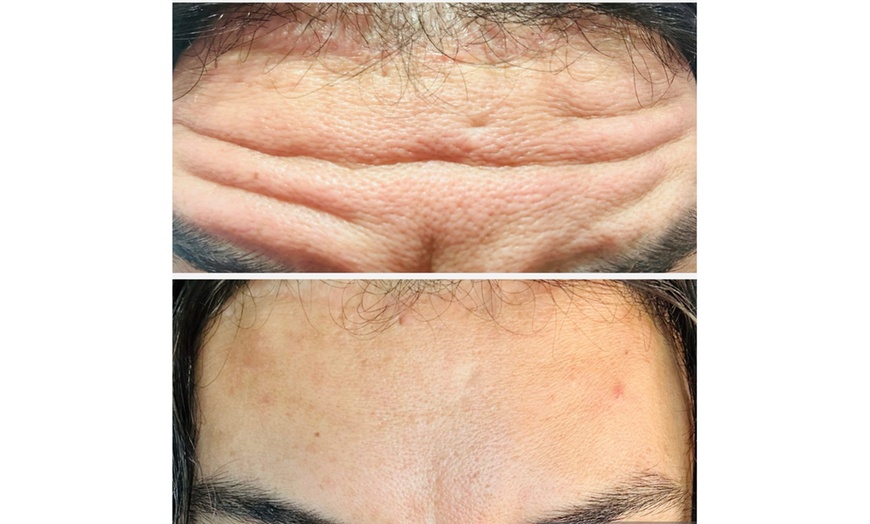 Image 5: Revitalize with 20 or 40 Units of Botox Or One Flip Lip