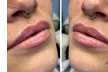 Achieve Enhanced Lips with Revanesse Versa (0.6mL) & Revanesse Lips (1.2mL) Dermal Fillers (Up to 56% Off) - Second Medium