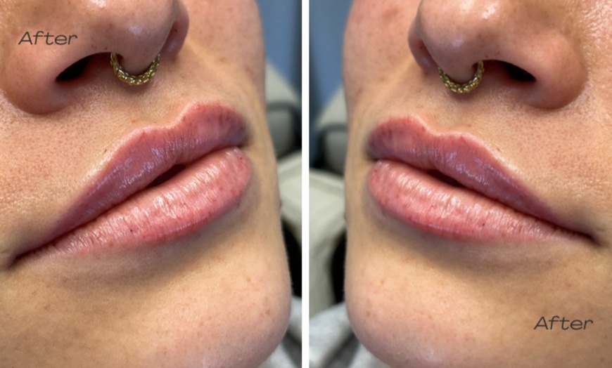 Image 2: Targeted Dermal Filler Treatments: Revanesse Versa & Lips