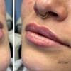 Image 2: Targeted Dermal Filler Treatments: Revanesse Versa & Lips