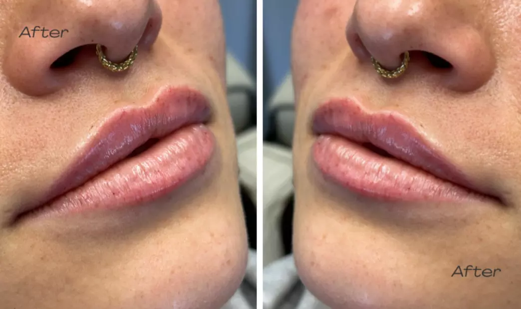 Targeted Dermal Filler Treatments: Revanesse Versa & Lips
