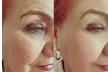29% Off 20 or 40 Units of Botox for Youthful Skin at Studio Donna Med Spa - Second Medium