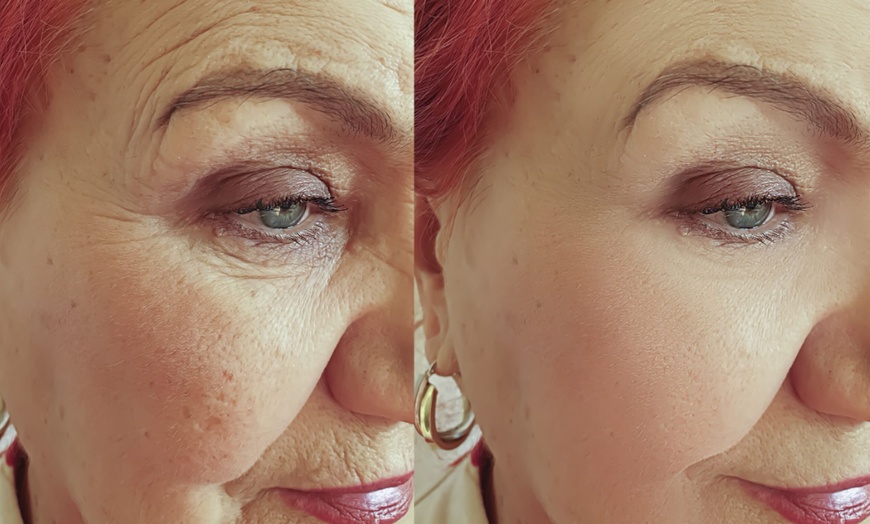 Image 2: Up to 15% Off Juvederm at Studio Donna Medical Spa