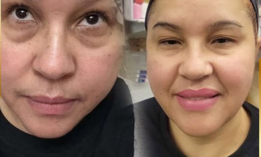 Image 6: Botox Units for Forehead Lines Crow Feet and Full Face Smoothing