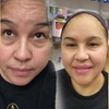 Image 6: Botox Units for Forehead Lines Crow Feet and Full Face Smoothing
