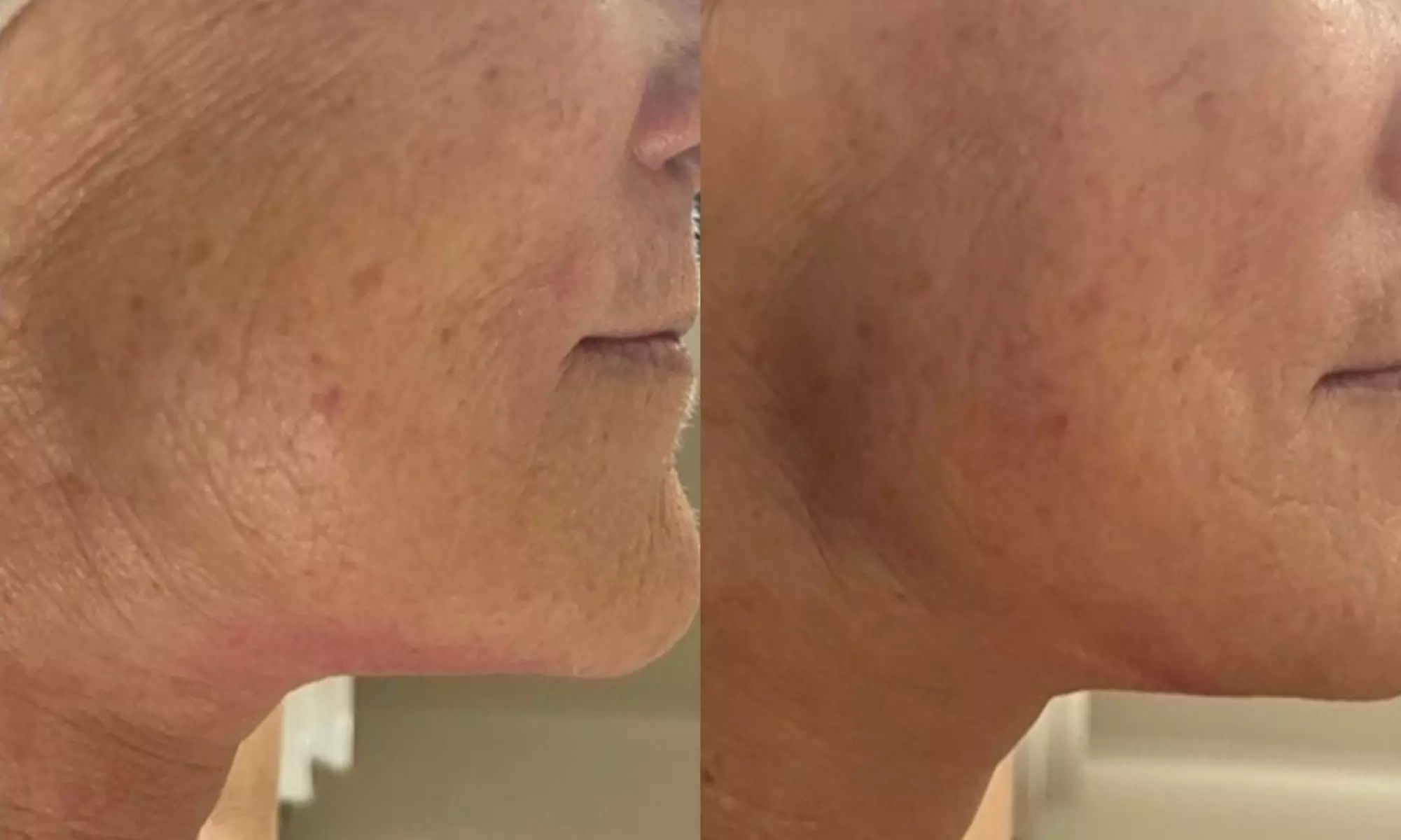 Radio Frequency Skin Tightening Treatment