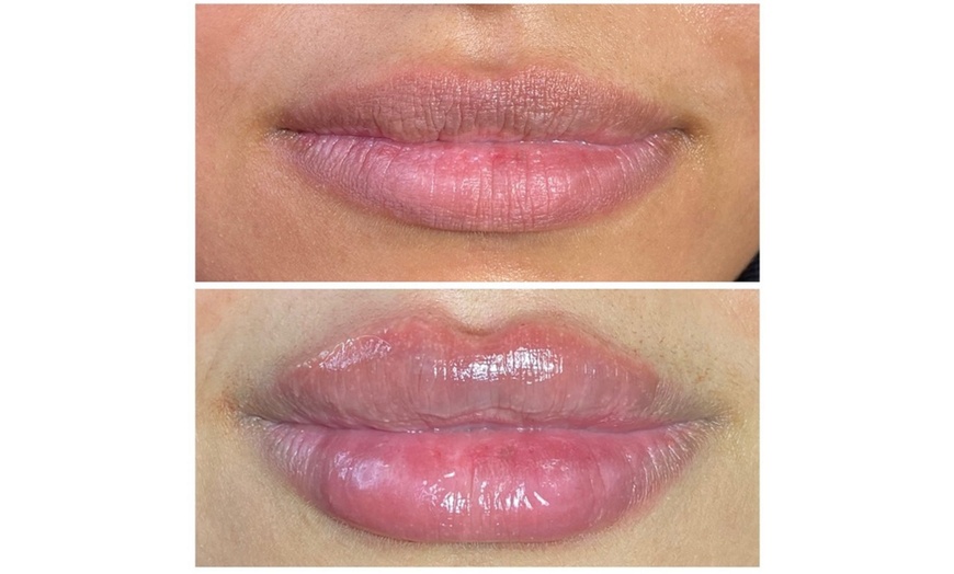 Image 9: Smooth, Plump & Perfect: Versa Enhancements at Divaa Beauty