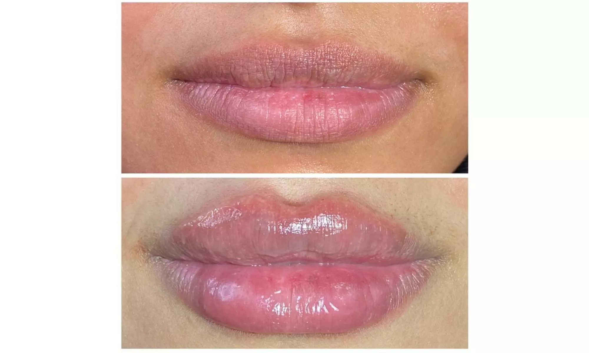 Smooth, Plump & Perfect: Versa Enhancements at Divaa Beauty