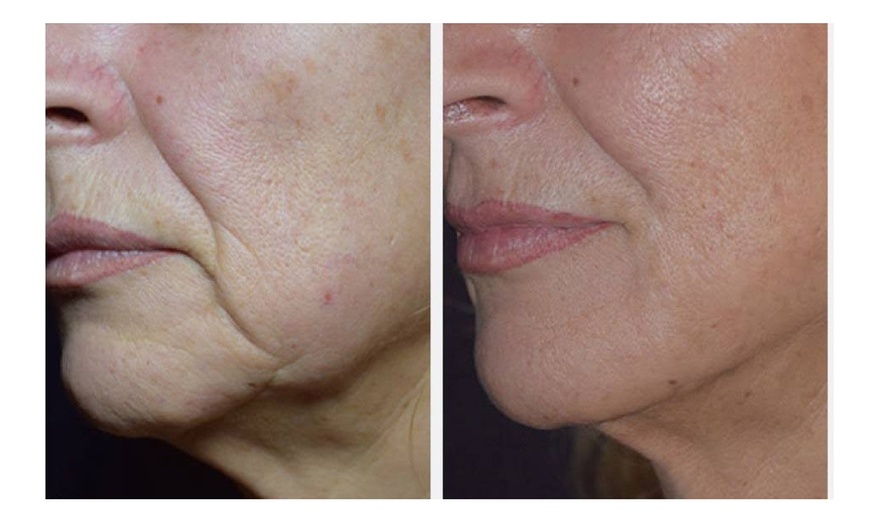 Image 3:  Face or Body (Belly/ Thigh) Fat Reduction W/ Forma Radiofrequency 