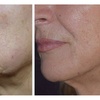 Image 3:  Face or Body (Belly/ Thigh) Fat Reduction W/ Forma Radiofrequency 