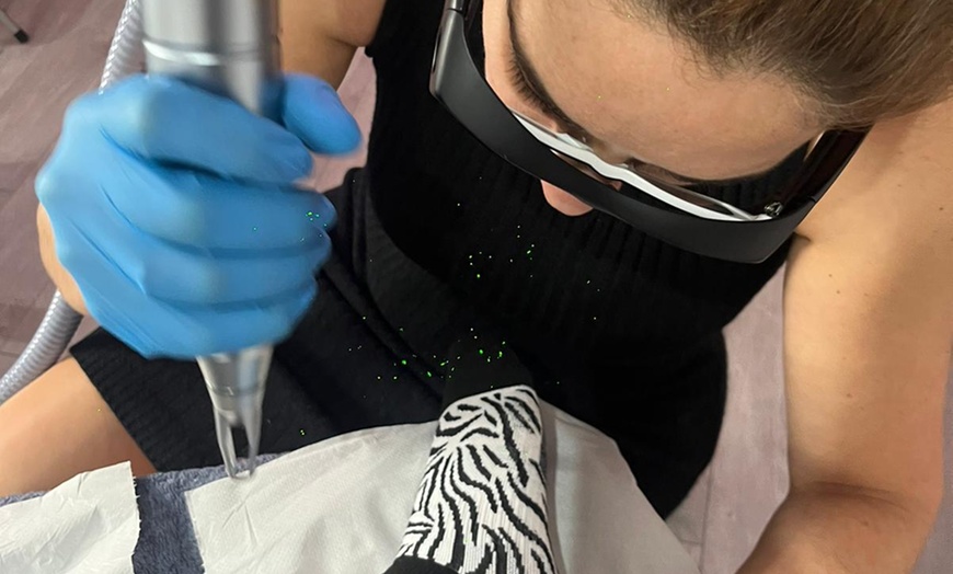 Image 3: 3 Sessions of Laser Pigment/Tattoo Removal (Up to 82% Off)