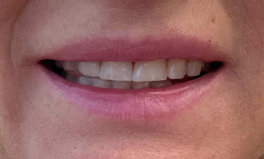 Image 3: Lip Flip or 20–40 Units of Xeomin for a Smooth, Youthful Look 