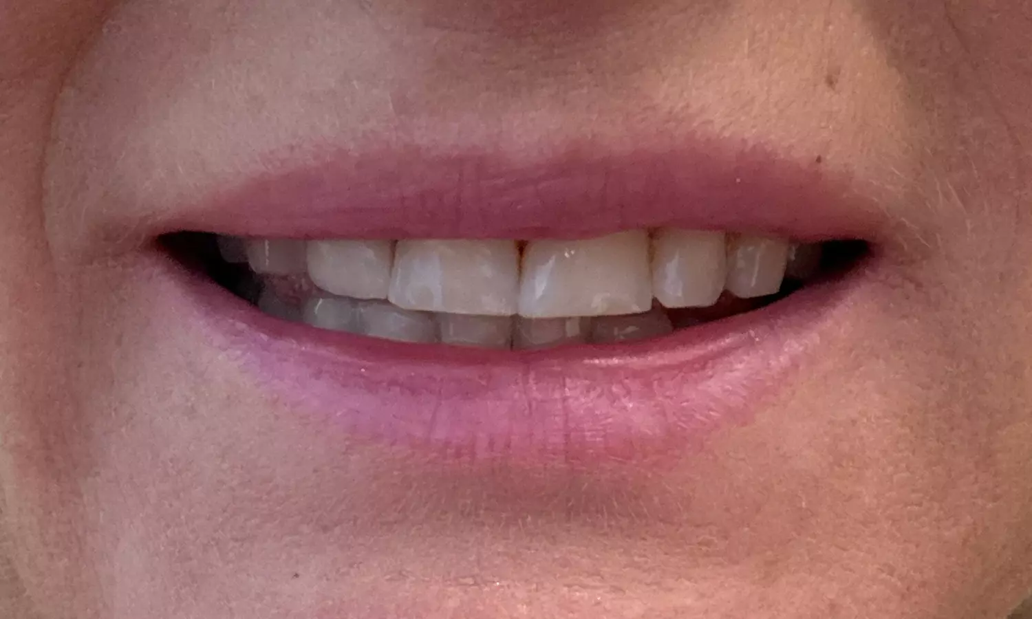 Lip Flip or 20–40 Units of Xeomin for a Smooth, Youthful Look