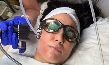 Co2 Laser Full Face - Rejuvenation 1 Session - Jems Laser & Aesthetics Liverpool Limited