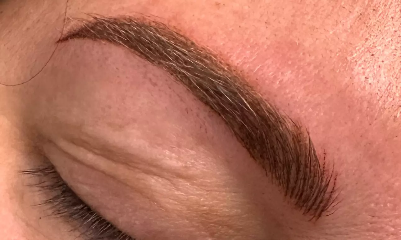 Nano Hair Stroke Brows, Microblading, or Skin Lesion or Mole Removal
