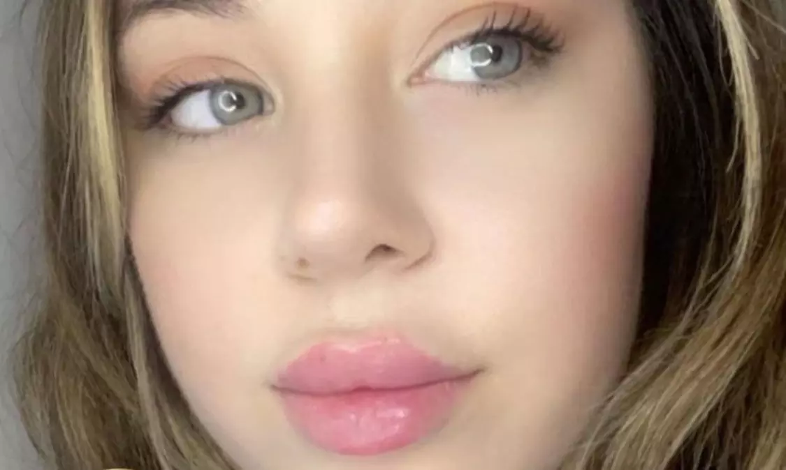 Targeted Dermal Filler Treatments for Lips, Eyes & Facial Lines