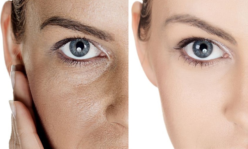 Image 2: Melano Peel Treatment w/ 4 LED Light Sessions & 2 Skin-Needling Option