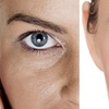 Image 2: Melano Peel Treatment w/ 4 LED Light Sessions & 2 Skin-Needling Option