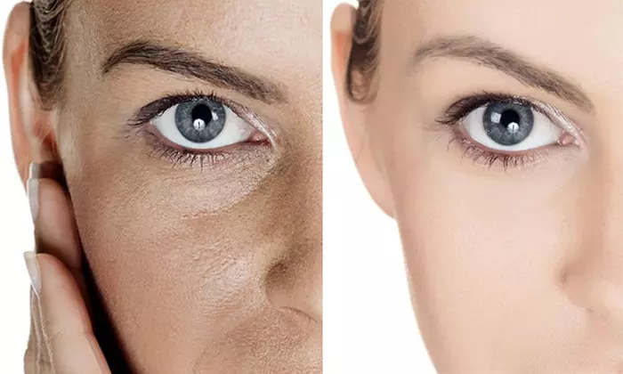 Melano Peel Treatment w/ 4 LED Light Sessions & 2 Skin-Needling Option