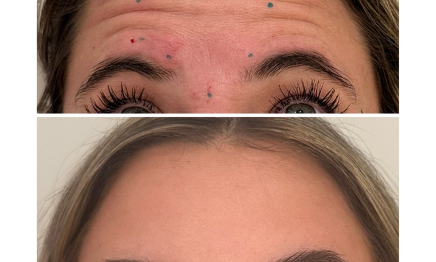 Image 2: 20, 40, or 60 Units of Letybo® Treatments for Smoother Skin