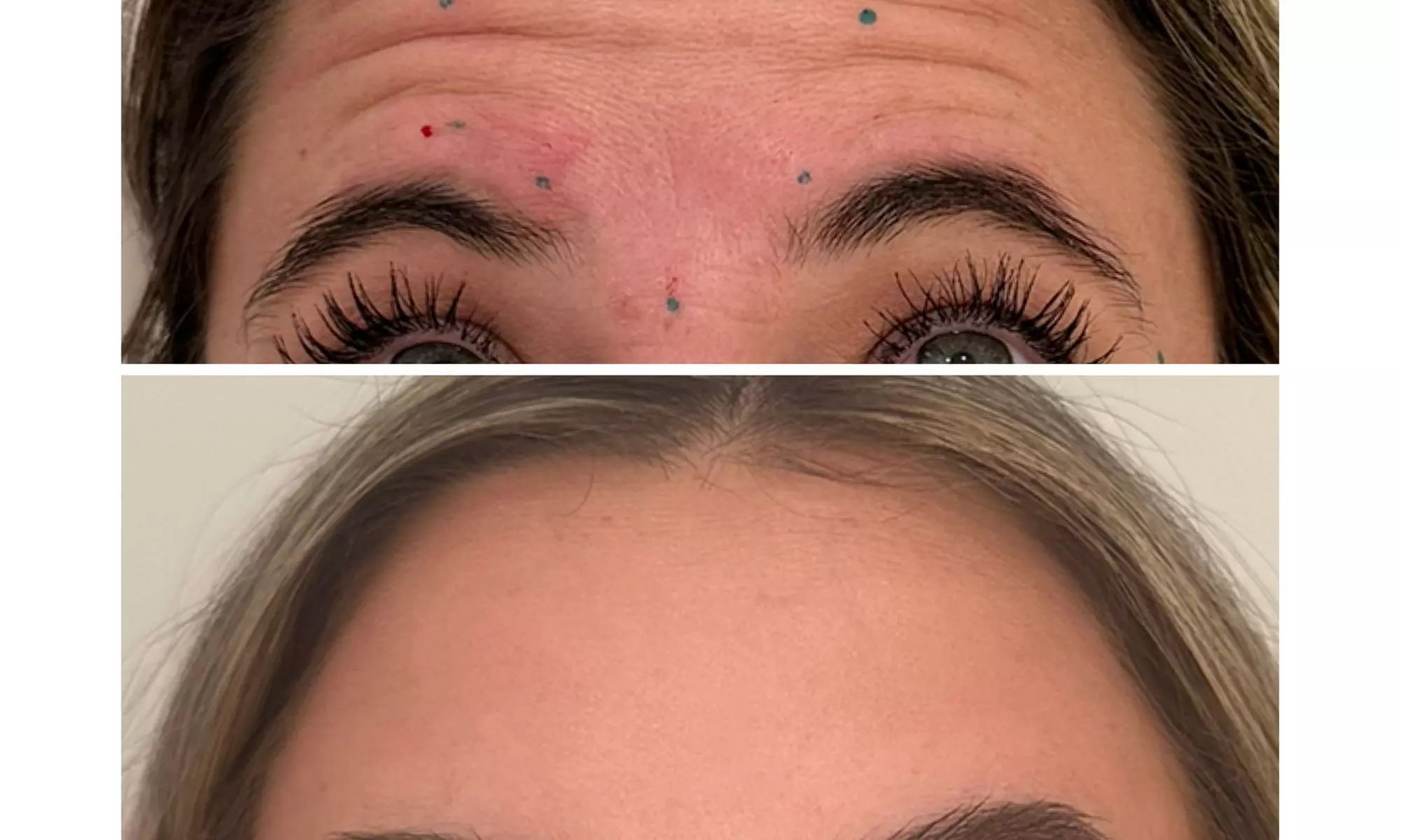Revitalize with 30 or 60 Units of Dysport at Youthful Glow