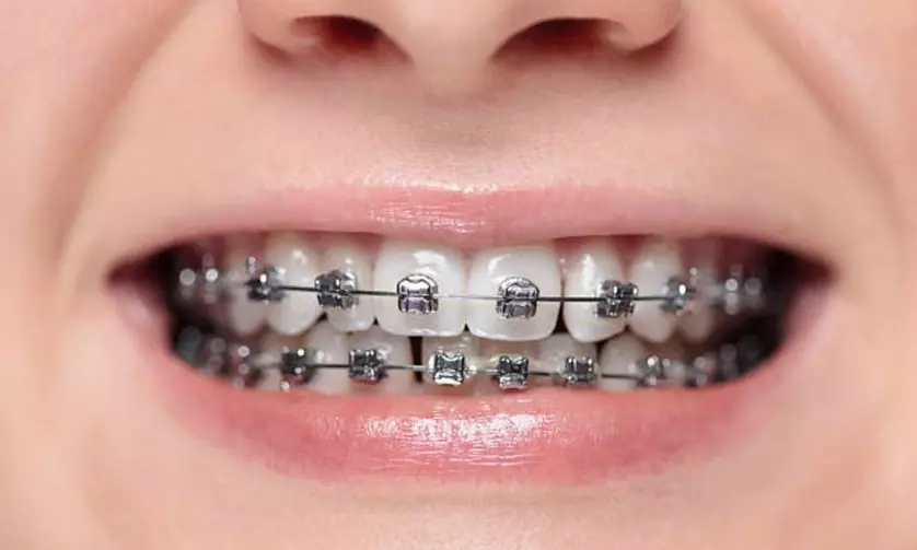 Ortodoncia metálica o estética con 6 meses de tratamiento