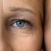 Image 1: Choose One or Two Sessions: Plasma Pen Fibroblast for Eyes or Any Area