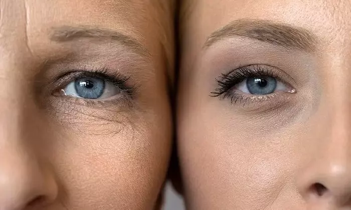 Choose One or Two Sessions: Plasma Pen Fibroblast for Eyes or Any Area