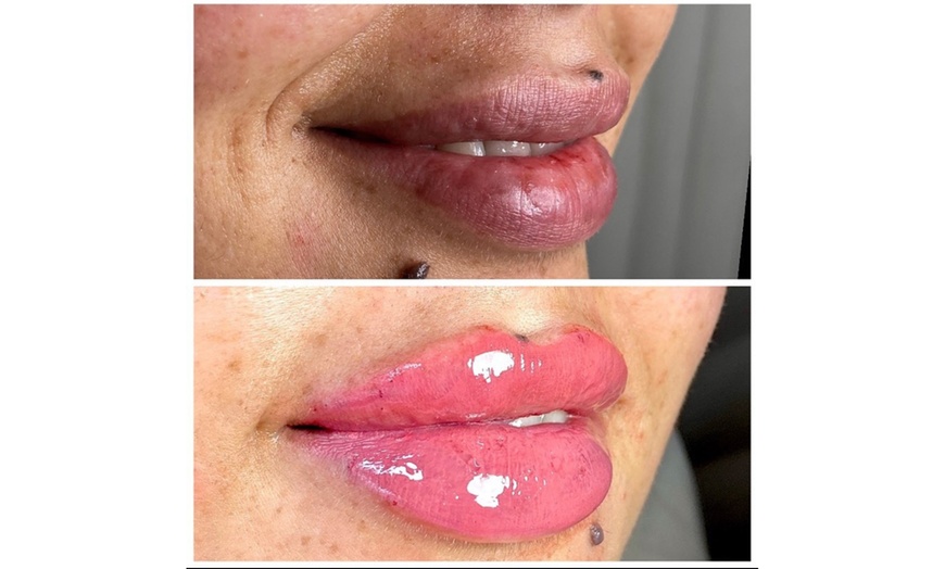 Image 8: Smooth, Plump & Perfect: Versa Enhancements at Divaa Beauty