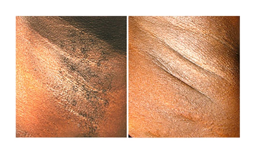 Image 5: 6 Sessions of Aerolase® Neo Elite Laser Hair Removal 