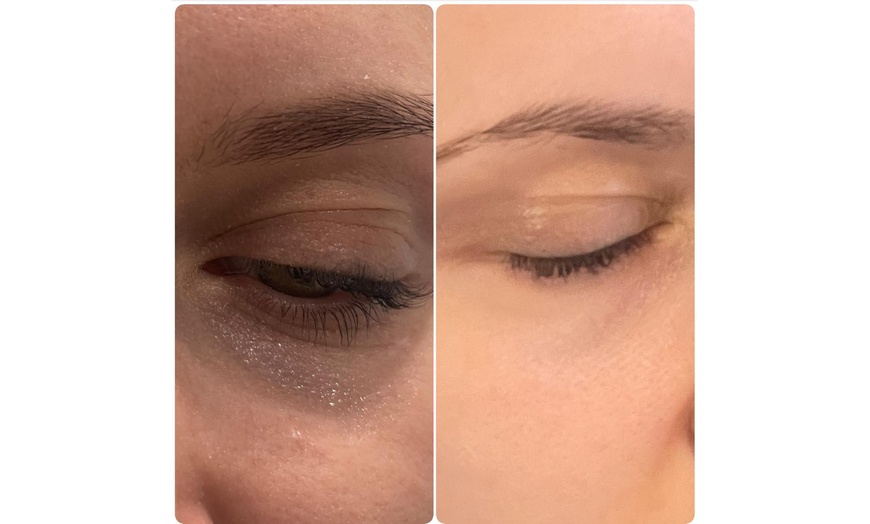 Image 3: Up to 63% Off on Dark Circle / Under Eye Treatment at My choice aesthetics