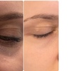 Image 3: Up to 63% Off on Dark Circle / Under Eye Treatment at My choice aesthetics