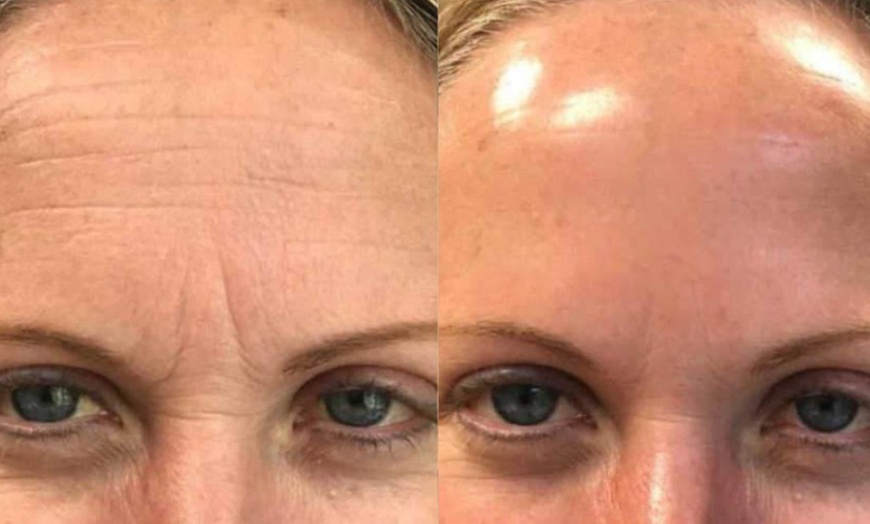 Image 3: RF Microneedling Treatment W/ Skin Nourishing Serum / Skin-Boosting 