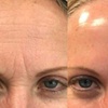 Image 3: RF Microneedling Treatment W/ Skin Nourishing Serum / Skin-Boosting 