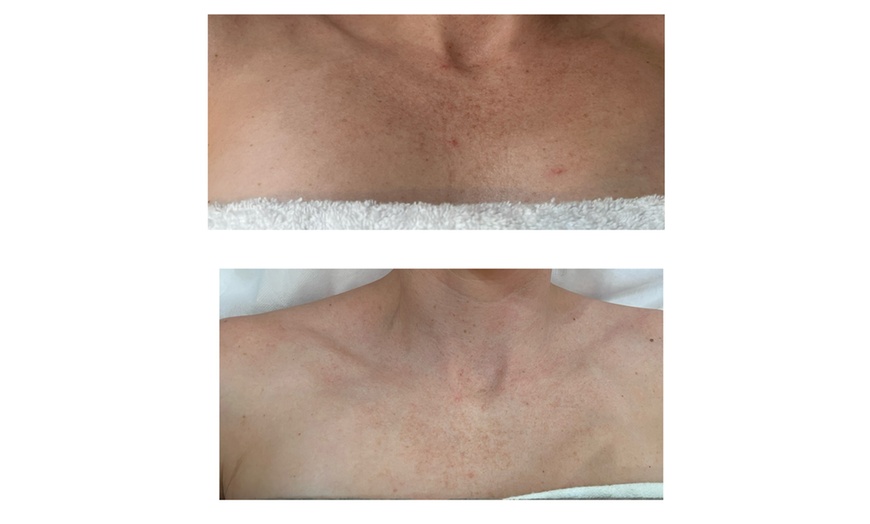 Image 3: 1 or 3 IPL Acne, Melasma, Brown Spots, or Rejuvenation Treatments
