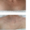 Image 3: 1 or 3 IPL Acne, Melasma, Brown Spots, or Rejuvenation Treatments
