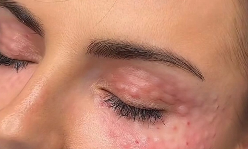 Image 1: Polynucleotide, Smooth line injections & Filler Combos 