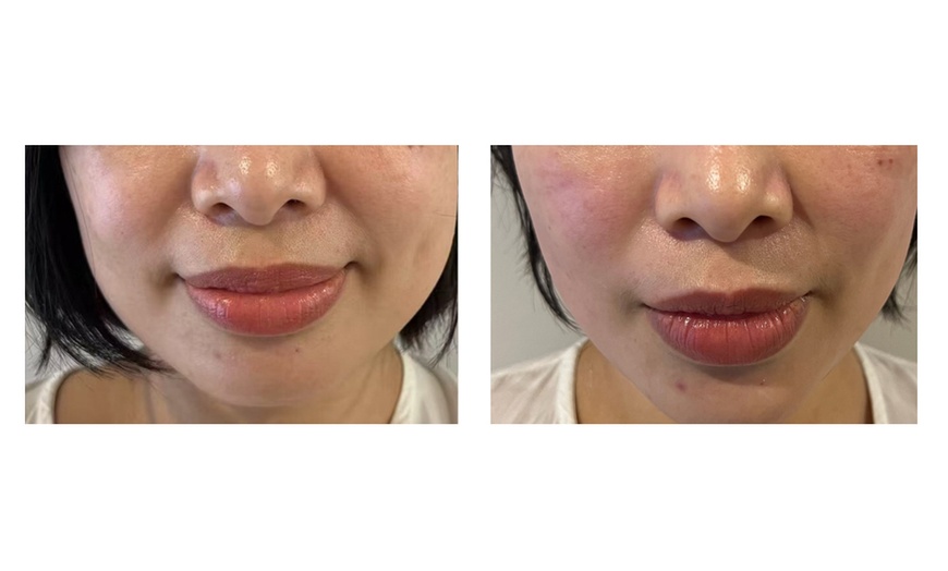 Image 2: FORDERM Treatment for One: 60 or 90 Minutes