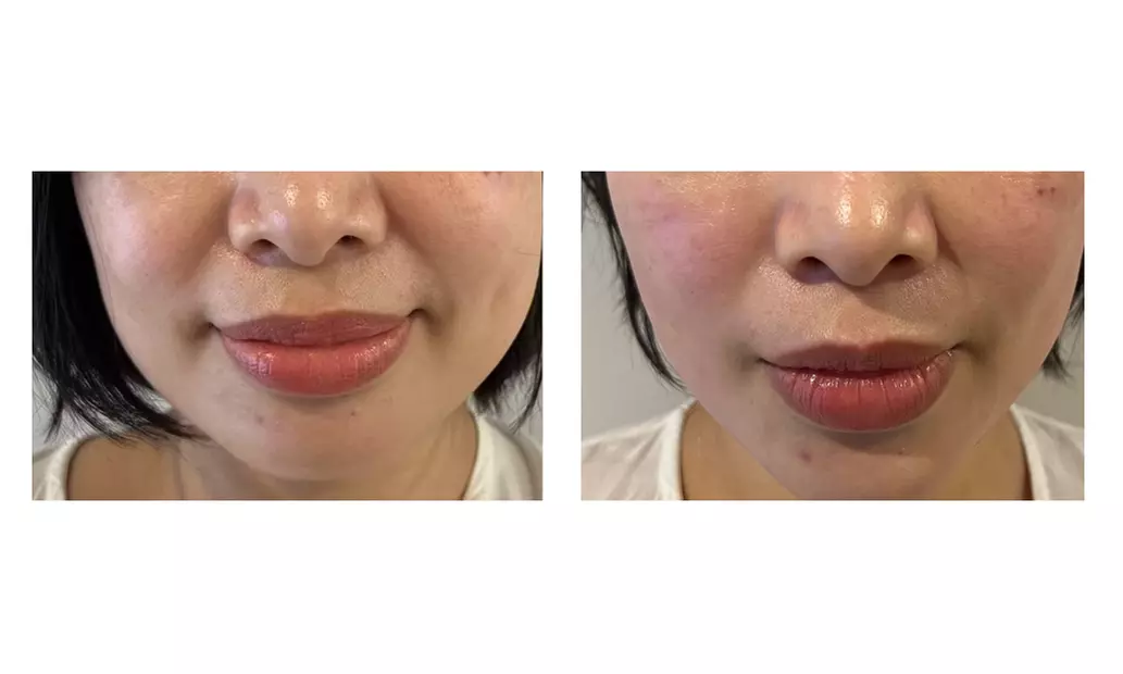 FORDERM Treatment for One: 60 or 90 Minutes