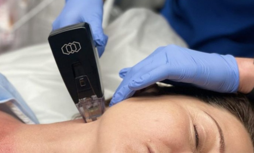 Image 3: Morpheus8 Non-surgical Tightening - Allure Passions Aesthetic Clinic