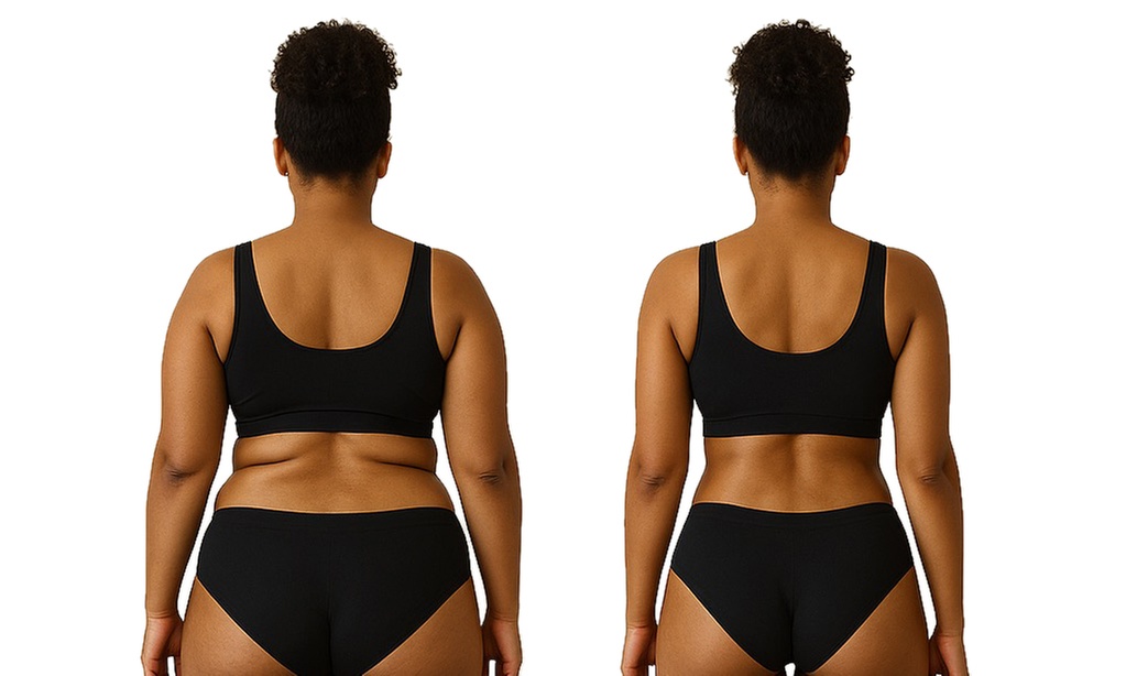 Chin, Back, or Belly—Slim Down Fast with Targeted Liquid Lipo