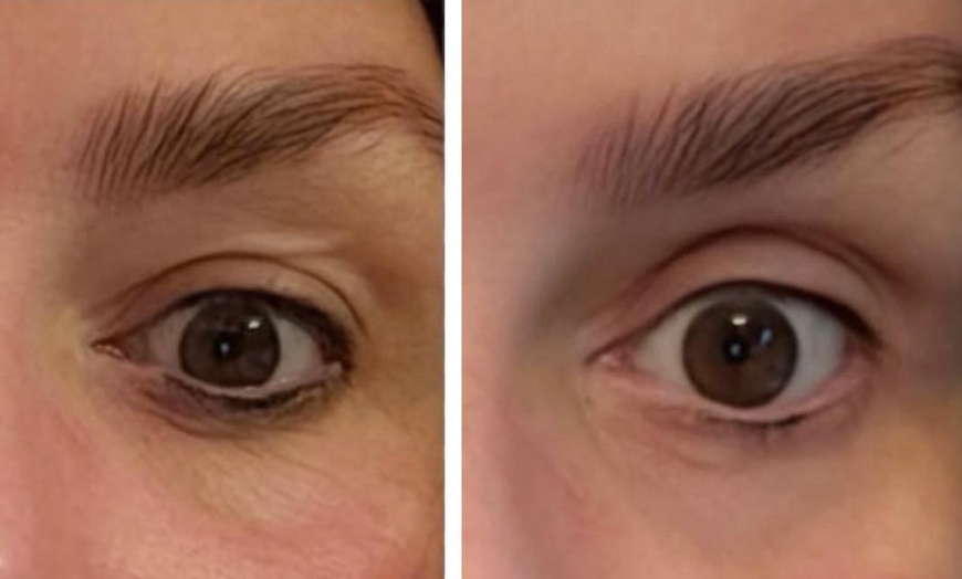 Image 2: Up to 63% Off on Dark Circle / Under Eye Treatment at My choice aesthetics