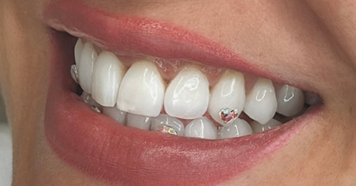 Servicio de joyas dentales y revisión odontológica en Madrid