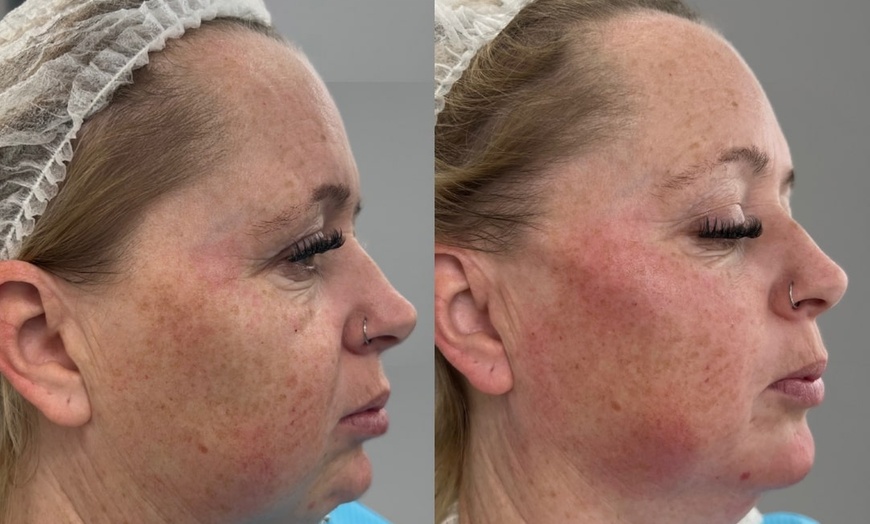 Image 7: Revitalize with 1ml, 2ml, or 3ml Dermal Fillers for Cheek, Jaw or Chin