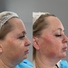 Image 7: Revitalize with 1ml, 2ml, or 3ml Dermal Fillers for Cheek, Jaw or Chin