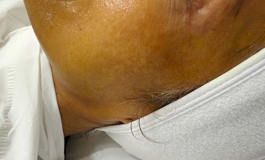 Image 3: Reveal Youthful Skin: One Chemical Peel at Floralis Aesthetics Clinic