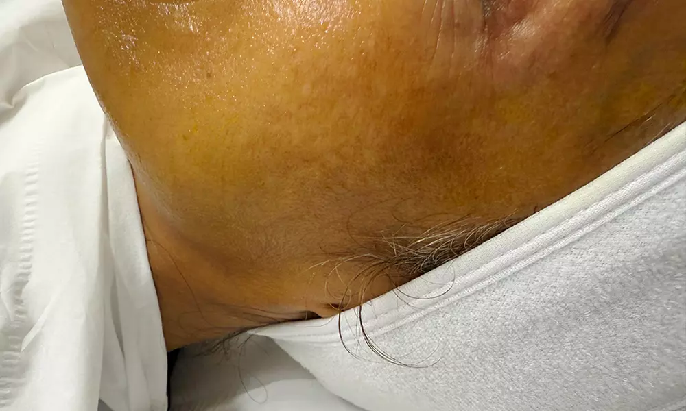 Reveal Youthful Skin: One Chemical Peel at Floralis Aesthetics Clinic