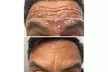 Lip Flip or 20–40 Xeomin Units for Smoother Skin & Fuller Lips at Slim Fit Beauty Up To  59% Off - Second Medium