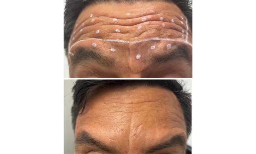 Image 2: Lip Flip or 20–40 Units of Xeomin for a Smooth, Youthful Look 